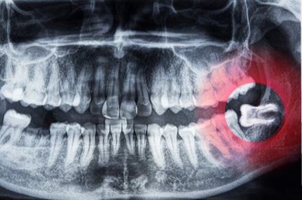 親知らずは全て抜いたほうが良いのか?