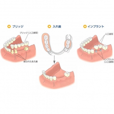 虫歯や歯周病などの原因により歯を失ってしまった後の咬み合わせの回復方法